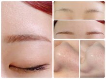 トータルビューティ ノイド(Noid)/いちご鼻撃退＋美眉毛WAX脱毛