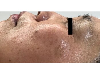 ピアーノ(PIANO)/エルモサハーブピーリング