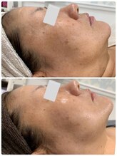 リュミエール デスポワール(Lumiere d'espoir)/ハーブピーリング