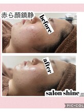 サロンシャイン(Salon Shine)/REVI陶肌トリートメント