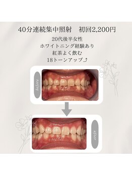 プラスビーセルフ(+b self)/ホワイトニングビフォーアフター