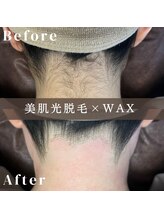 エピナ 横浜店(Epina)/うなじ脱毛/ブライダル脱毛