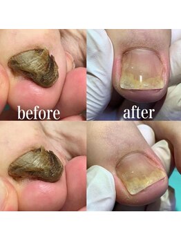 巻き爪補正店 町田店/変形爪