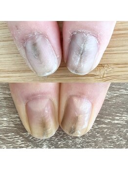 ウェルズユキ(well's yuki)/ガタガタした爪/凹凸のある爪