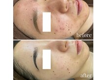 ゾーンビューティーハウス 松戸店(ZONE BEAUTY HOUSE)の雰囲気（ニキビケア★肌の根本から集中肌質改善により徹底ケア 可◎）