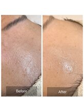 ガレリア エステ 名駅(GALLARIA)/お肌を押し上げてふっくら♪