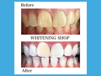 ホワイトニングショップ 福岡春日店/笑顔に自信、白さで決まる！