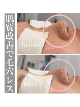 マルコ(marco)/毛穴レス　症例