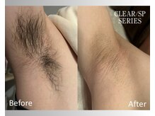 アップパイン(UPPINE)/ワキ脱毛¥1,650/大国町