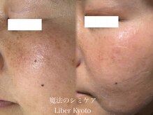 エステティック リベル キョウト 京都駅前店(Esthetic Liber Kyoto)/魔法のシミケア