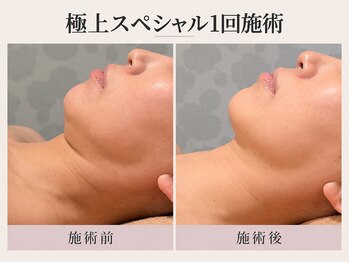 トリプルサンショップ 京都店の写真/【京都/四条】くすみ・シミ・透明感不足に。明るく澄んだ印象を目指す大人の美白フェイシャルケア