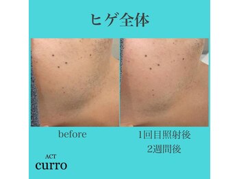 アクト クロ(ACT curro)/【ヒゲ全体】脱毛施術例