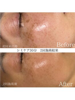 リフィール(Re:feel)/シミケア30分2回施術