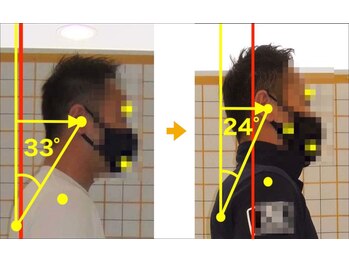 リファイン(Refine)/頭部前方(TE角)男性1