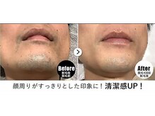 RBL セントシティ小倉店/メンズ脱毛/ヒゲ脱毛4回目剃毛後