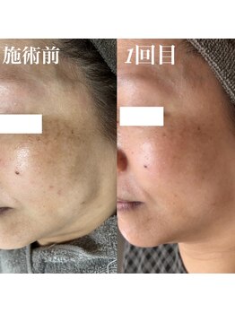 コリー(Kolly)/シミケア