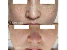 ソイ(Soi)/8回でのお肌変化♪