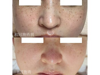 ソイ(Soi)/8回でのお肌変化♪