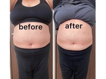 ビーエフジー(B F G)/強力痩身