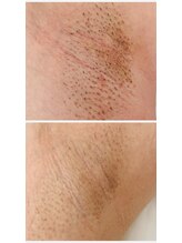 リアン(Rian)/光脱毛／わき脱毛