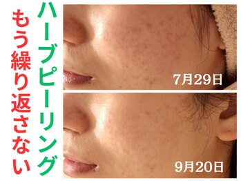 エリン(ERIN)/毛穴徹底洗浄×ハーブピーリング