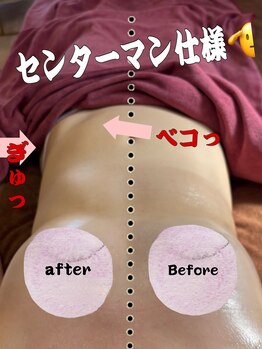 カシェボーテ(CACHE BEAUTE)/痩身の左側のみ施術後