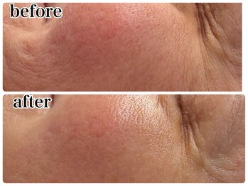 エミマス ボーテ(Emimas Beaute’)/気になる表情ジワ改善には幹細胞