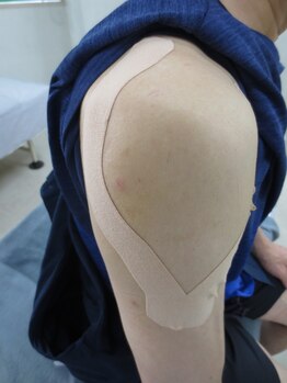 カイロプラクティック 大森整体院/テーピング施術例（肩／三角筋）