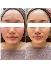 ココユール(cocoyull)/ハーブピーリング