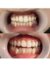 セルフメイド 石巻店/ホワイトニングビフォーアフター