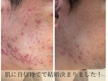 ポアレ(POARE)の雰囲気(ニキビを隠せない男性も清潔感と自信up!人生変わるモテ肌へ)