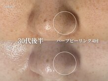 コウル 川西能勢口店(geoul)/毛穴レス美肌コース＋毛穴洗浄