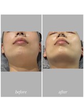 bou 新宿/切らないサクション？！