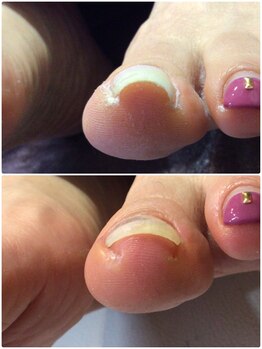 モアクリスタル(More Crystal)/巻き爪補正