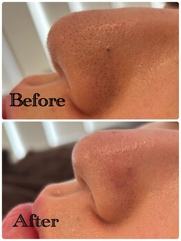 グラサヴォーグ 金沢店/長年の黒ずみの悩みが一度で変化