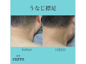 アクト クロ(ACT curro)/【うなじ襟足】脱毛施術例