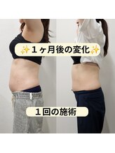 カナエル(Kanaeru)/脂肪を減少する痩身機器あります