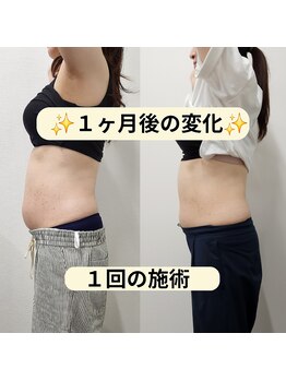 カナエル(Kanaeru)/脂肪を減少する痩身機器あります