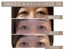 ドクターボディ 恵比寿店(Dr.Body)/【目のしわ/目のくま 50代】