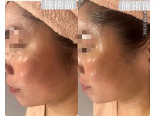 ハイフン(HIFUN)/【小顔×チタニウムリフト】