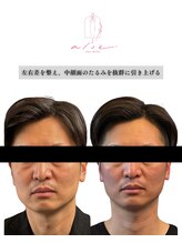 アロエベル(aloe Belle)/Before After（4回施術）