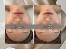 ゴールデンケア(goldencare)/【中顔面短縮＆リフトアップ希望