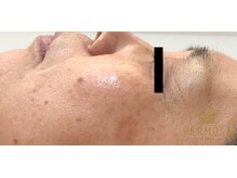 ピアーノ(PIANO)/エルモサハーブピーリング