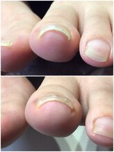 モアクリスタル(More Crystal)/巻き爪補正