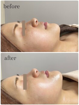 ルシアル(Rucial)/剥けない!ハーブピーリング