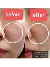 脱毛エステティックサロン ビビ(vivi)/毛穴洗浄