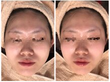 リボディ プラチナ(Rebody platinum)/小顔リフェイスコラーゲンリフト