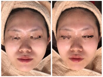 リボディ プラチナ(Rebody platinum)/小顔リフェイスコラーゲンリフト