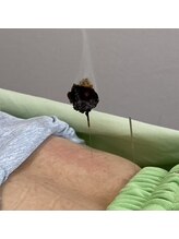 ジェネ鍼灸院/灸頭鍼
