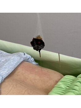 ジェネ鍼灸院/灸頭鍼